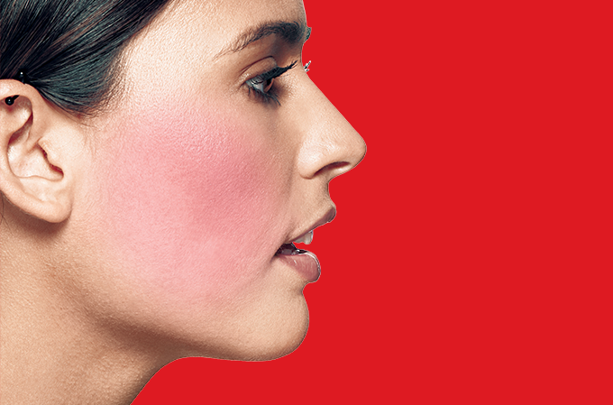 o-que-causa-rosacea