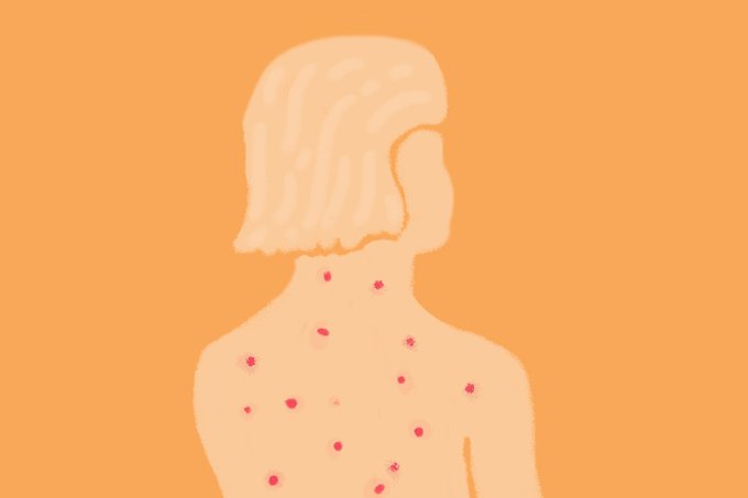 Governo barra vacina da herpes-zóster no SUS: saiba a quem é indicada e quanto custa na rede privada