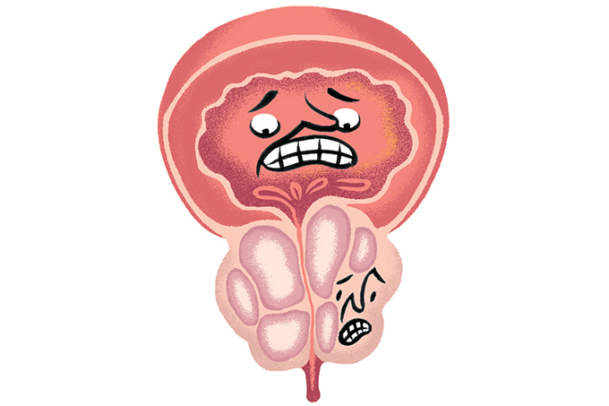 Próstata inchada: entenda o problema, sintomas, causas e tratamentos