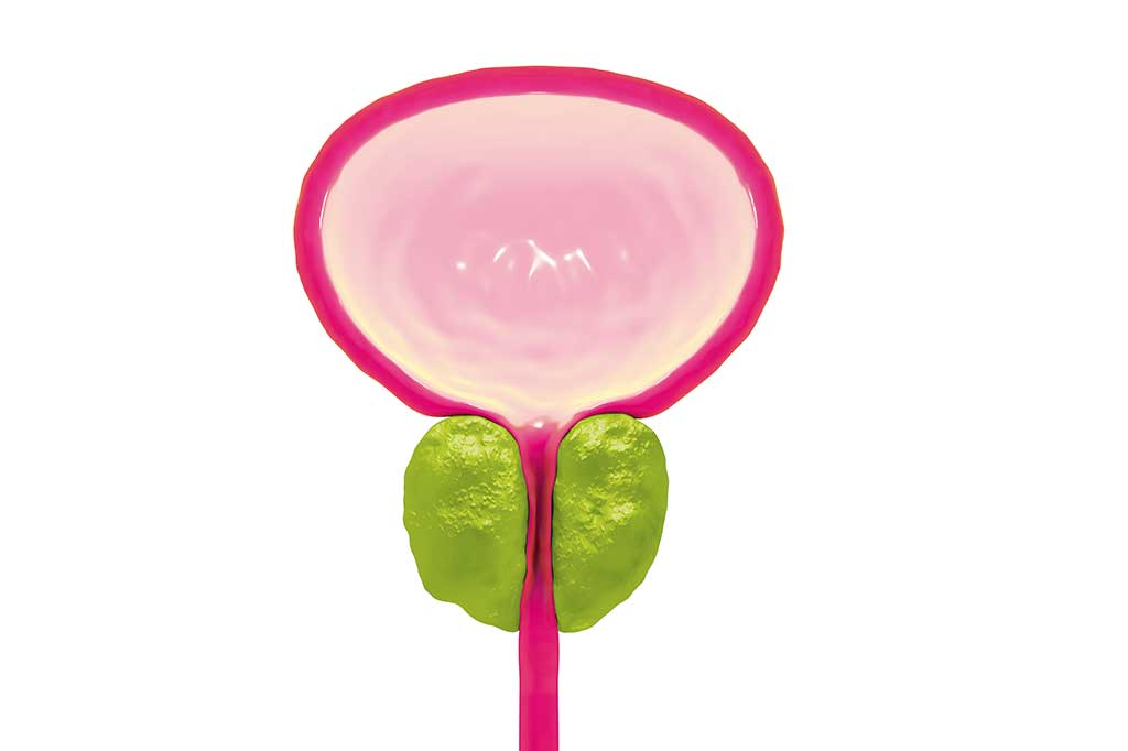 Técnica à base de vapor d’água diminui próstata inchada