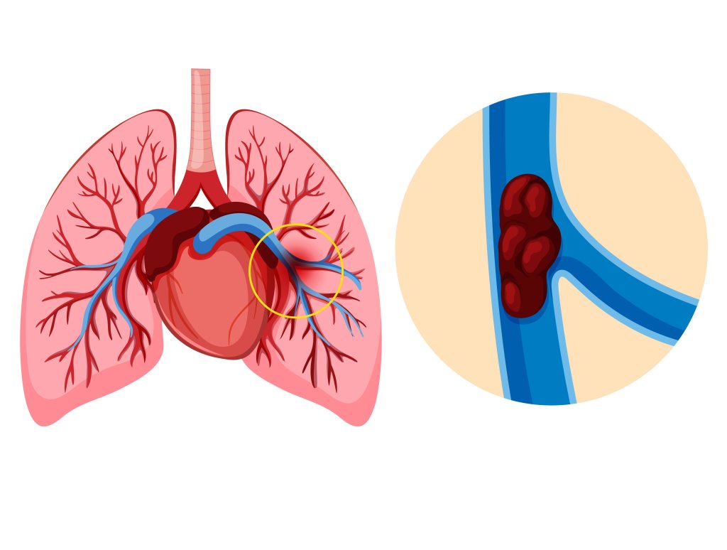 Embolia pulmonar: entenda causa da morte de mulher que fez seis plásticas