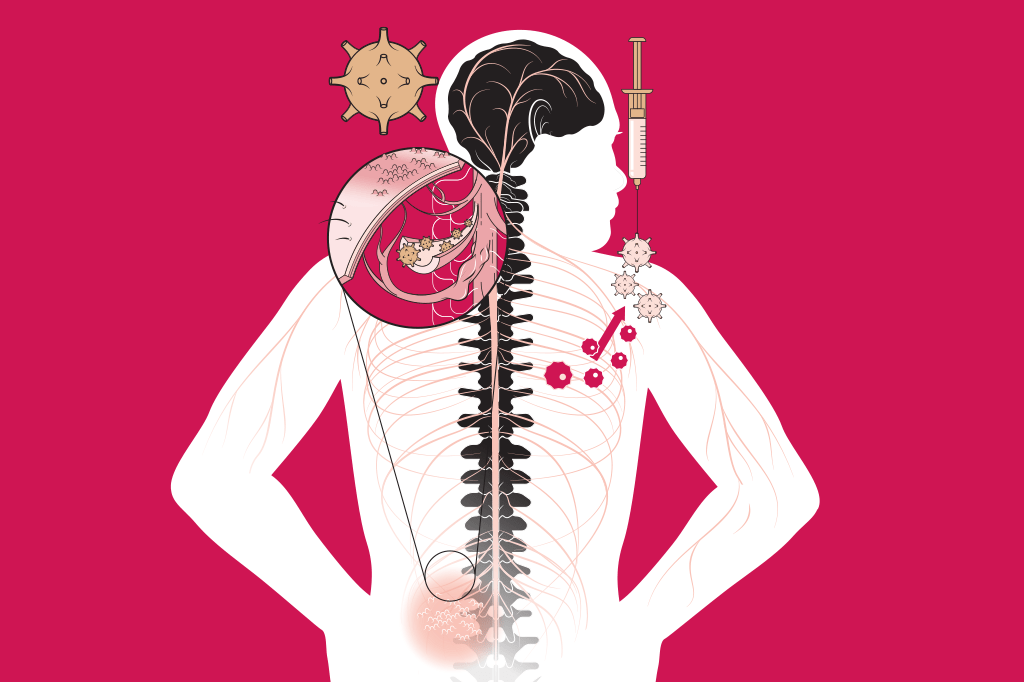 Por que é importante se vacinar contra o herpes-zóster?