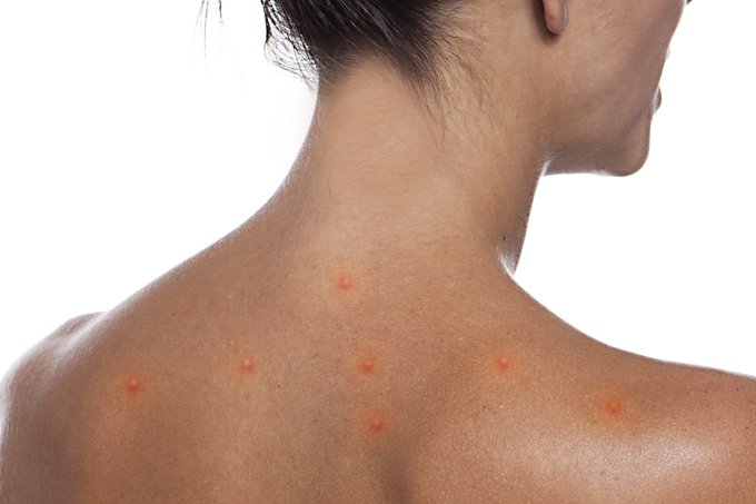 Acne não tem idade