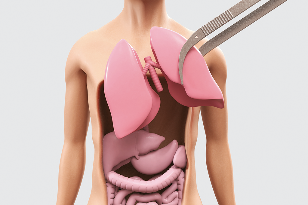 Transplantes: inovações visam diminuir a espera por órgãos