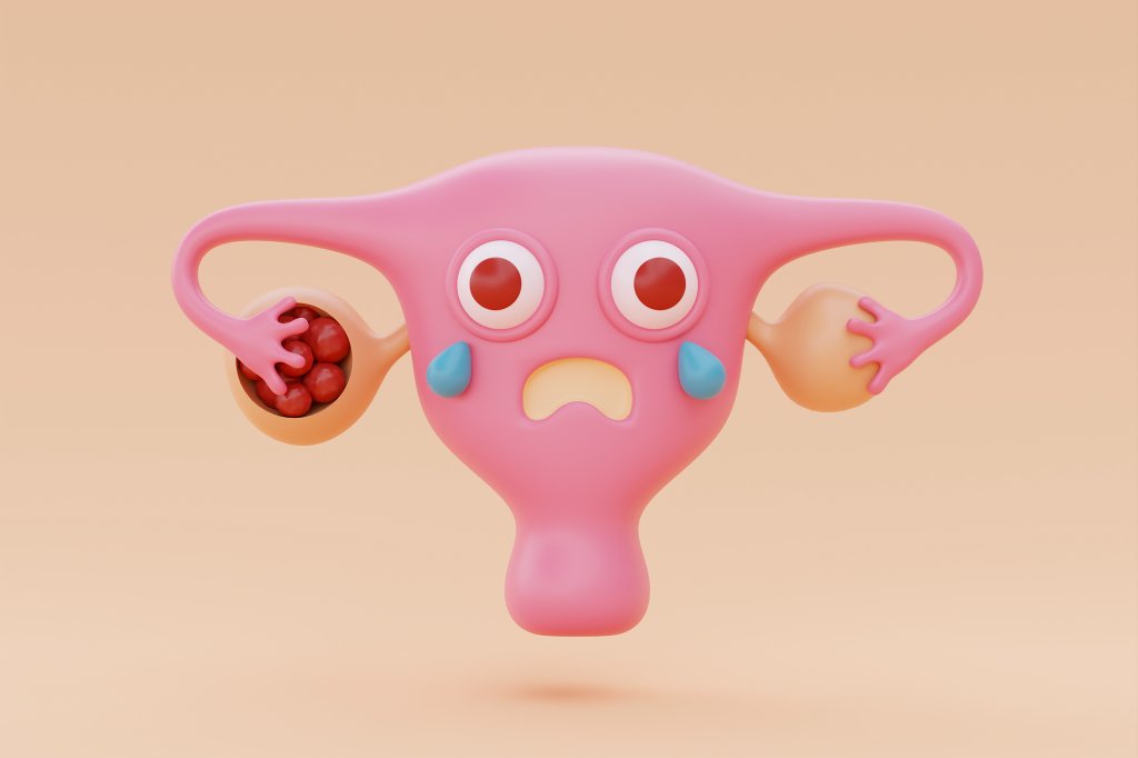 Cisto no ovário: quais as causas e como tratar