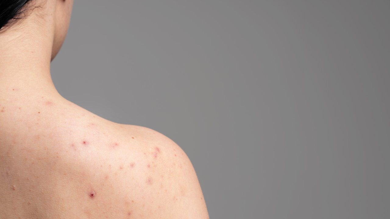 furunculo-o-que-e-como-tratar-e-prevenir