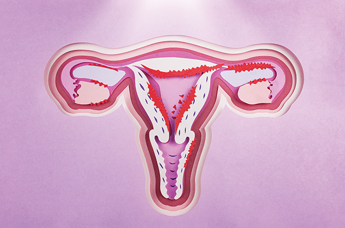 mes-da-endometriose