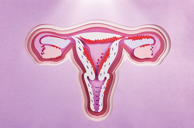 Endometriomas: o que são os cistos relacionados à endometriose e como tratá-los