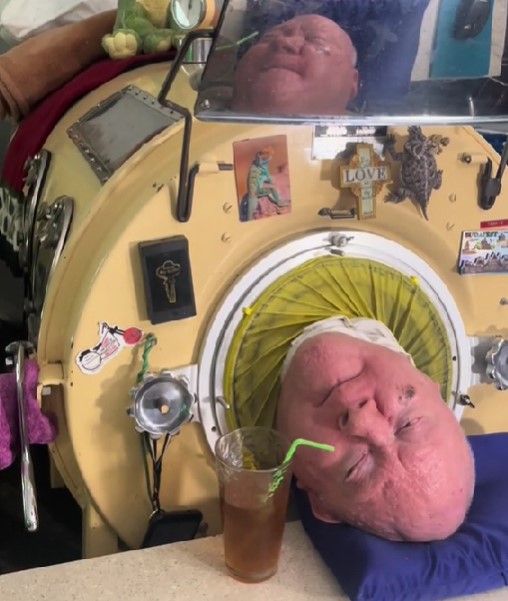 O que é o “pulmão de ferro”, dispositivo utilizado por Paul Alexander