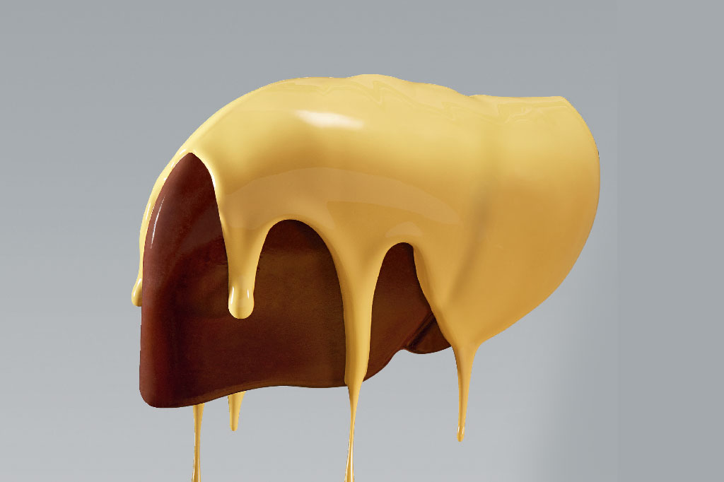 Semaglutida: estudo mostra efeito em casos avançados de gordura no fígado