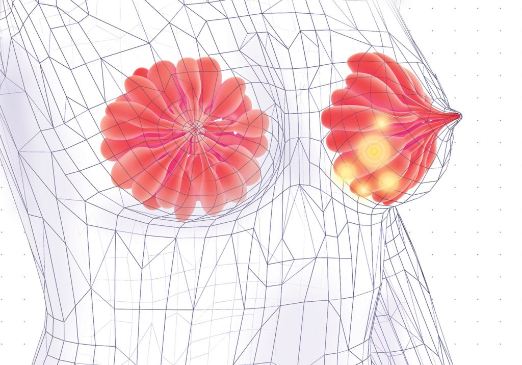 É necessário rever as políticas de atenção ao câncer de mama no Brasil