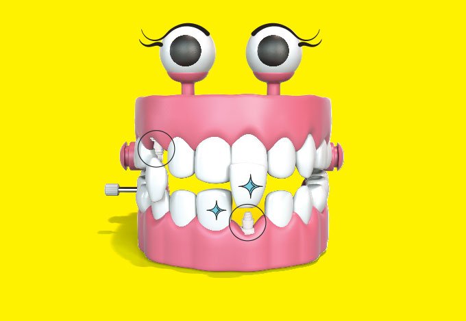 Implante, prótese e coroa dentária: quais as diferenças entre eles?