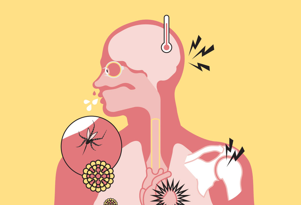 Dengue: conheça os sintomas da doença e saiba quando buscar atendimento médico