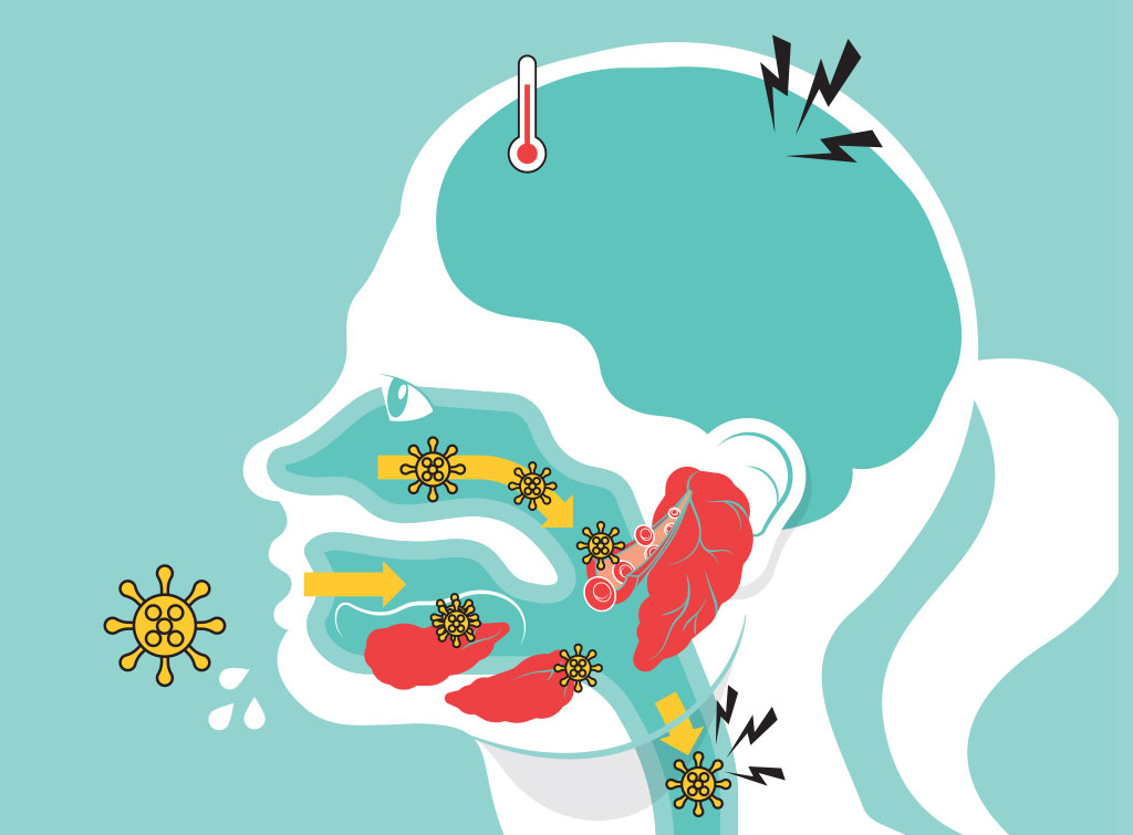 Por que a vacina contra a caxumba precisa estar em dia?