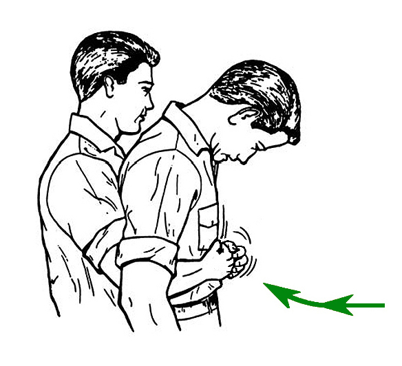 manobra-de-heimlich-como-fazer-em-adultos manobra-de-heimlich-como-fazer-em-adultos