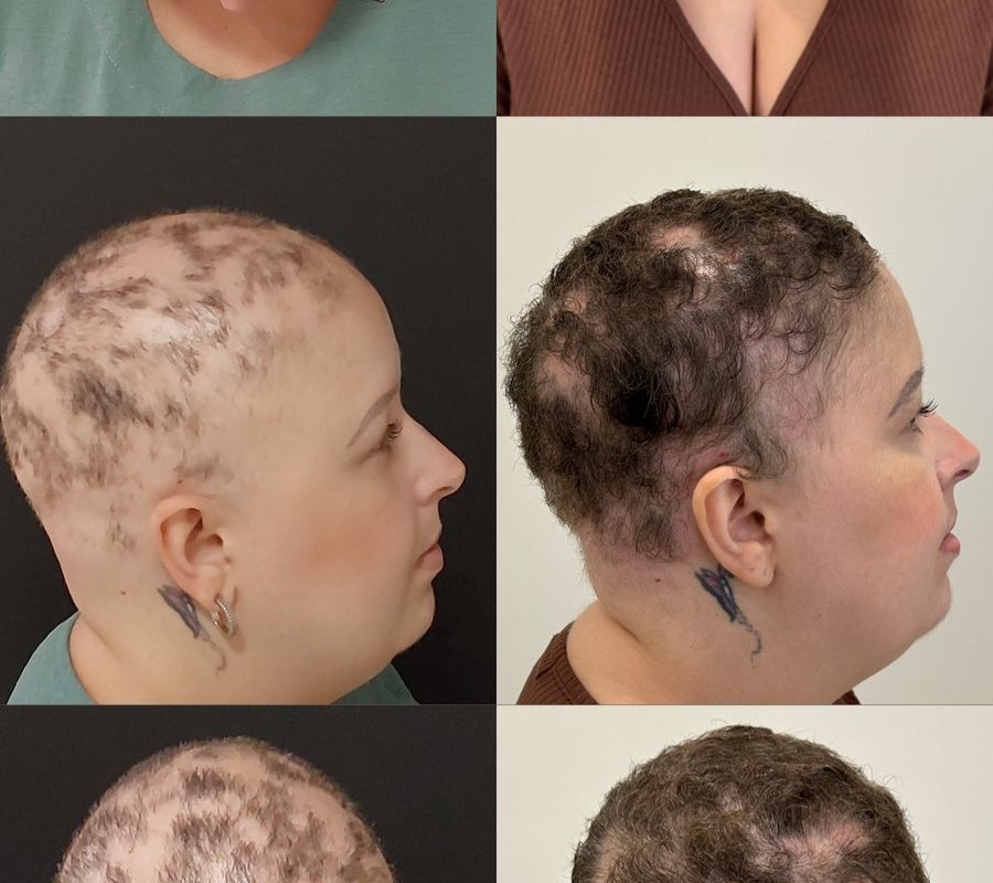 “Quase aceitei que seria careca para sempre”