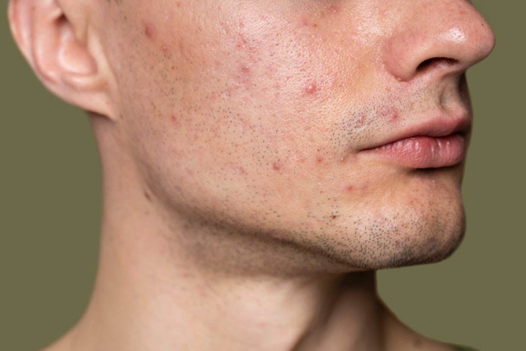 Acne: 7 fatores que pioram o problema na pele