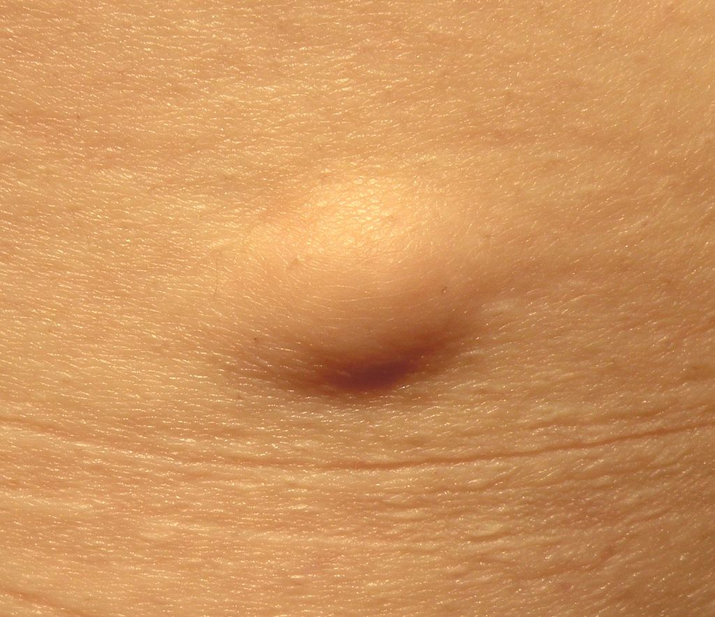 Lipoma: conheça as causas e os sintomas desse tumor benigno