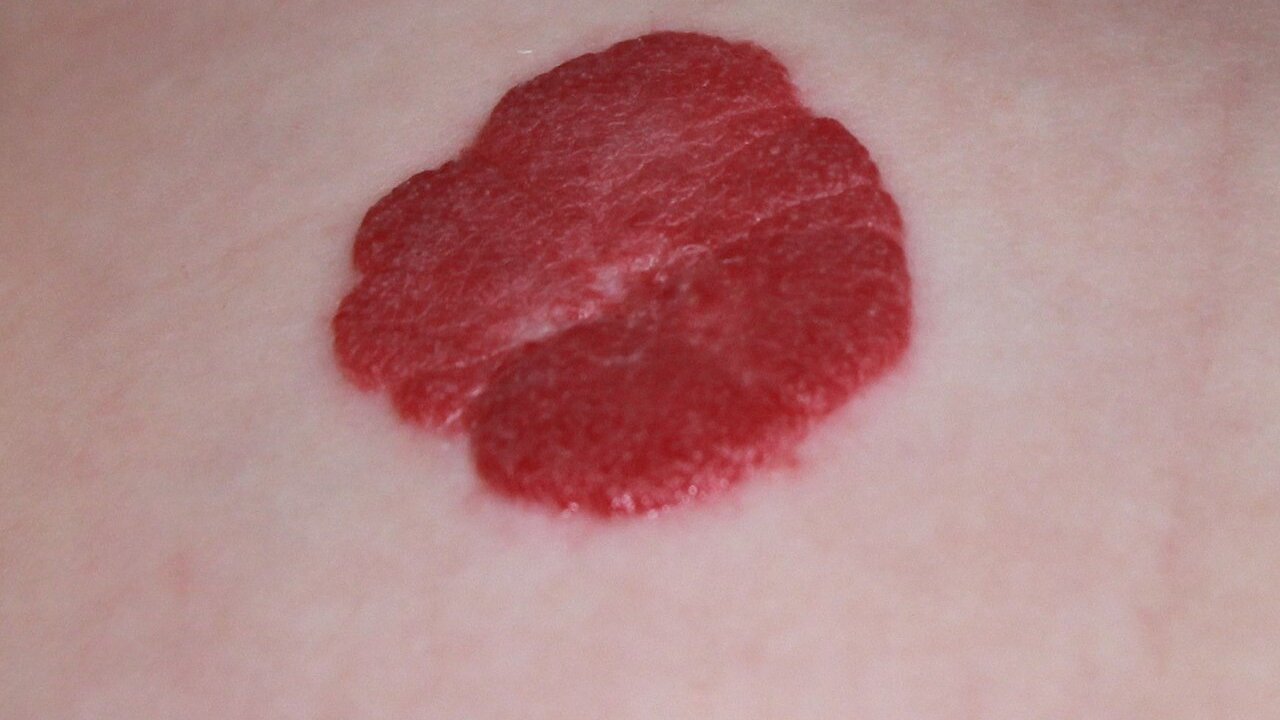 hemangioma-sintomas-causas-tratamento