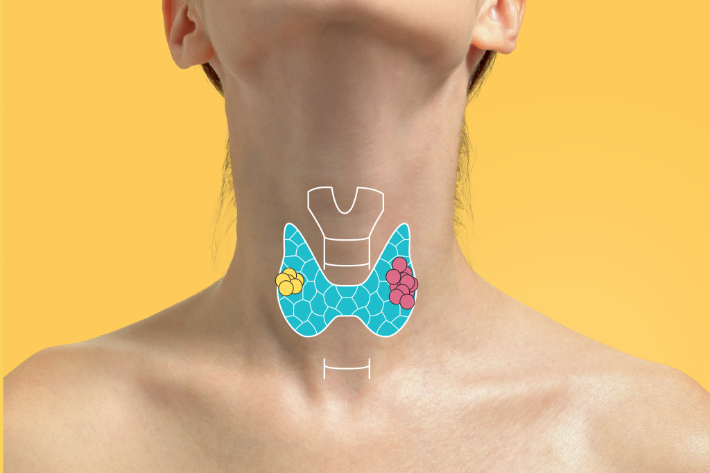 Qual a diferença entre um nódulo e um tumor de tireoide?
