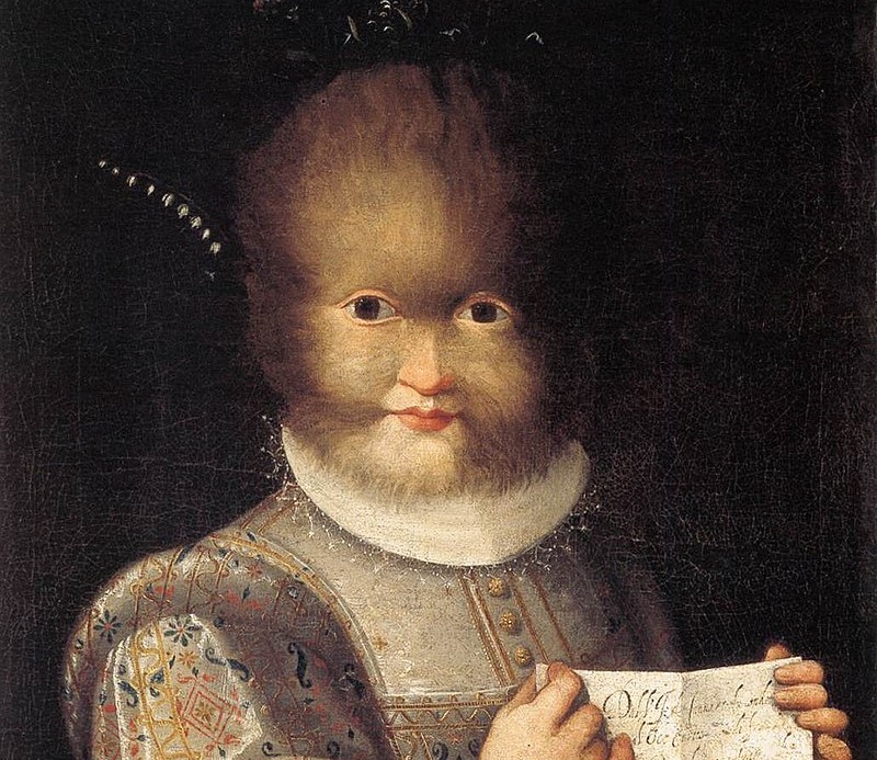 Loção para calvície pode causar “síndrome do lobisomem” em bebês