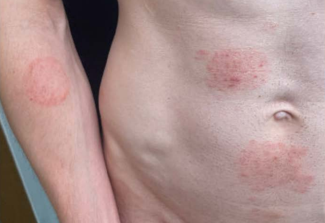 Superfungo transmitido sexualmente: o que se sabe sobre casos na Europa e EUA