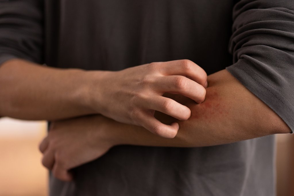 O que fazer para aliviar a coceira de picadas de mosquitos?
