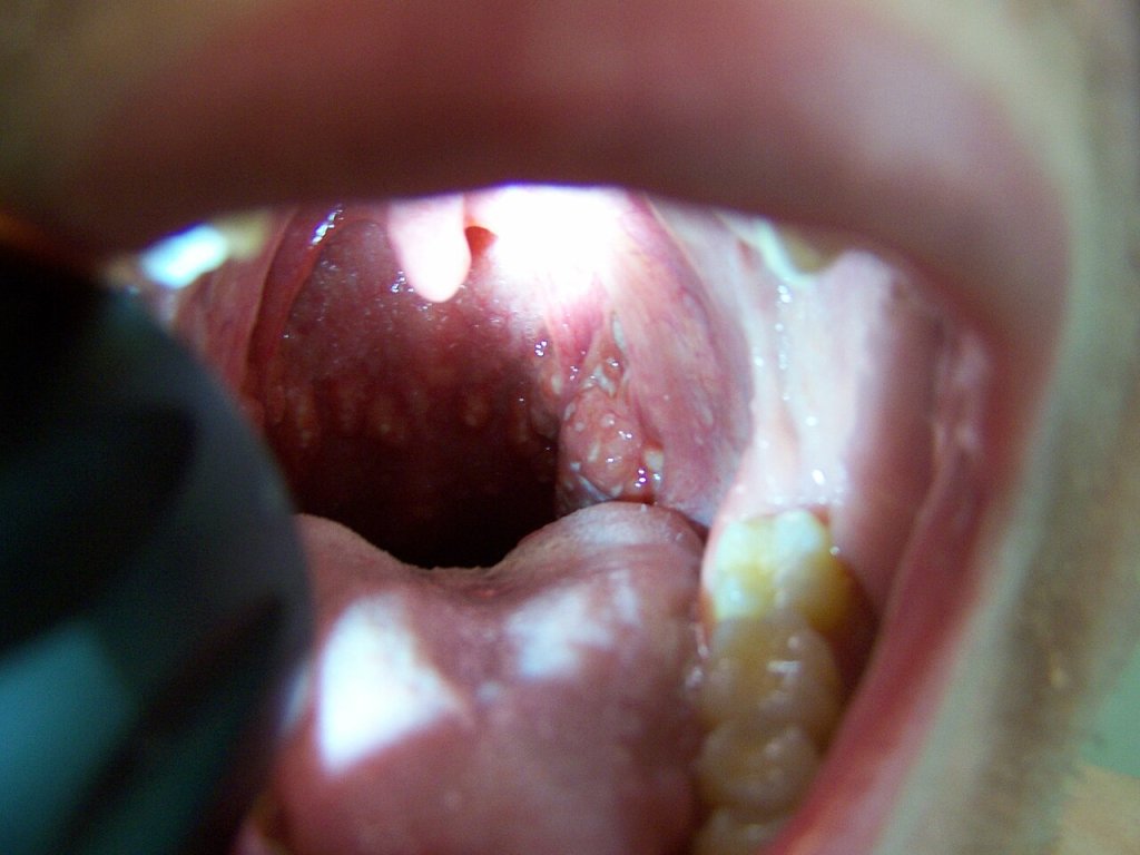 Herpangina: conheça infecção que causa febre alta e feridas bucais