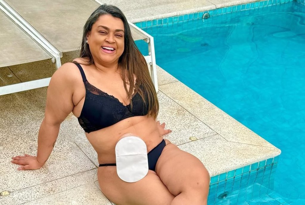 Colostomia definitiva: saiba quando é indicada a cirurgia feita por Preta Gil