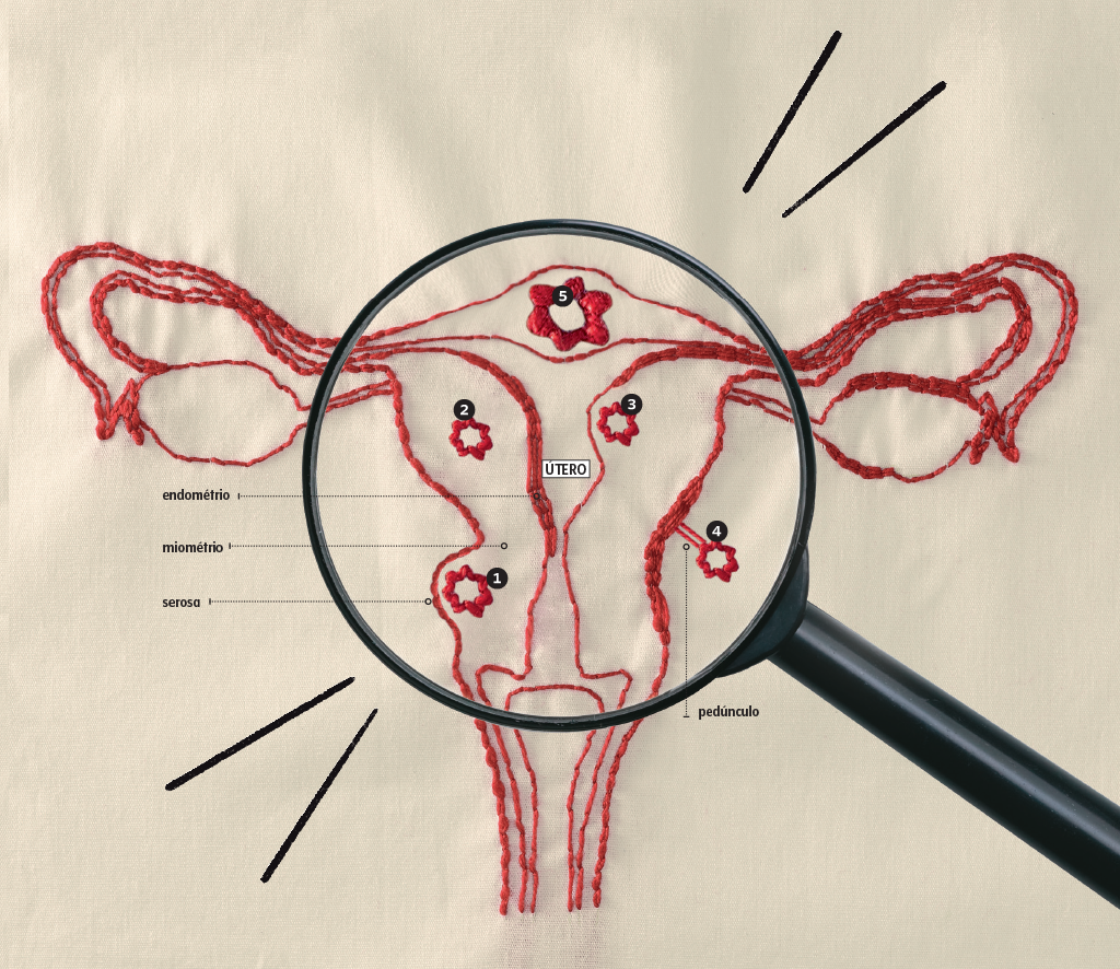 miomas-utero miomas-utero
