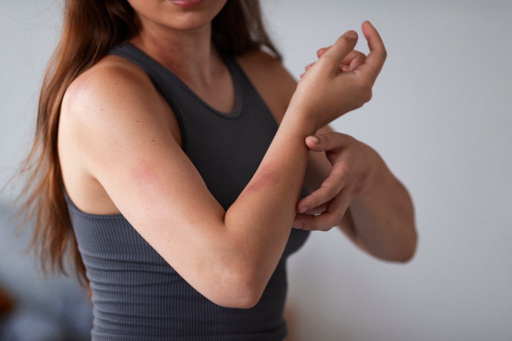 Alergia ao suor? Conheça a urticária colinérgica