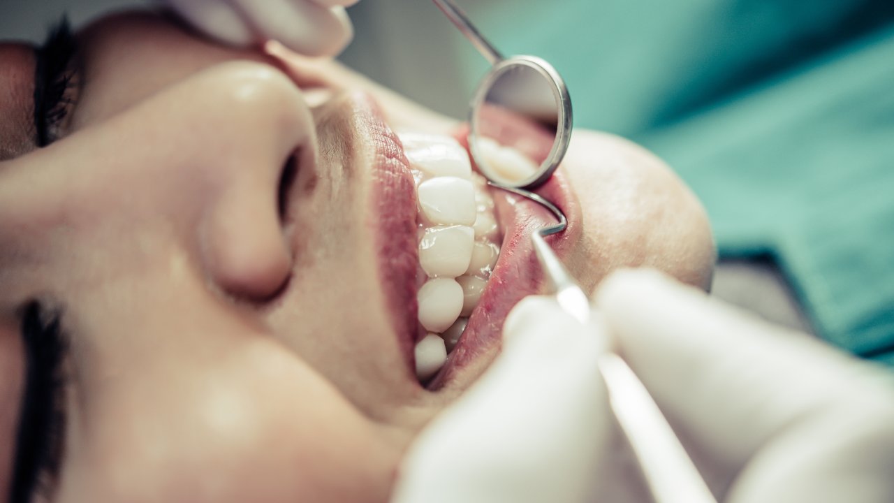 dentista-restauração-dente