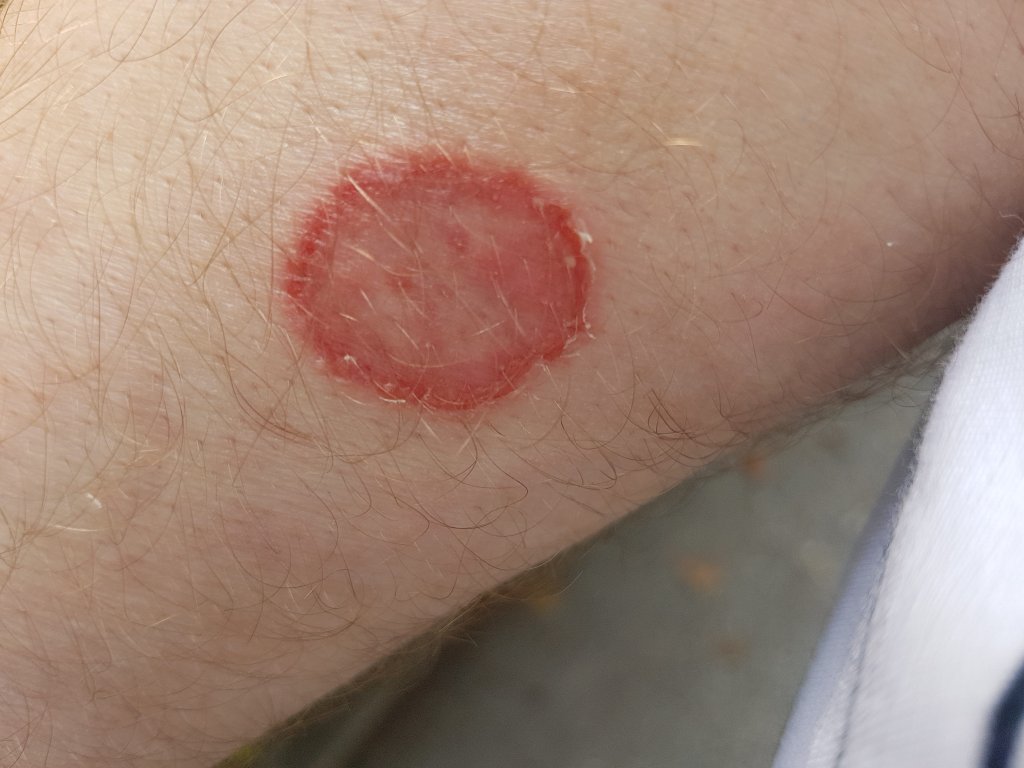 Dermatofitose: infecção causa coceira e vermelhidão na pele