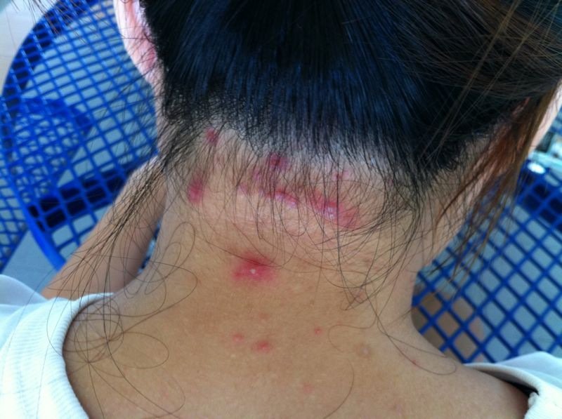 Foliculite capilar: como tratar a inflamação do couro cabeludo