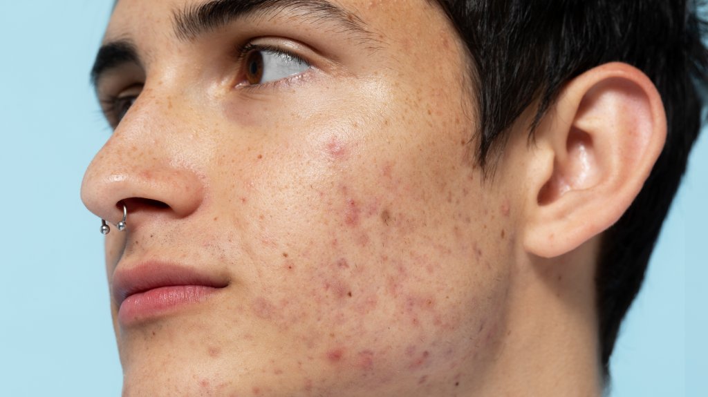 Como tirar manchas de espinhas? Aprenda a resolver o incômodo