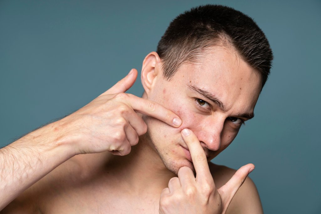Pústulas ou espinhas? Entenda as diferenças e conheça os tratamentos