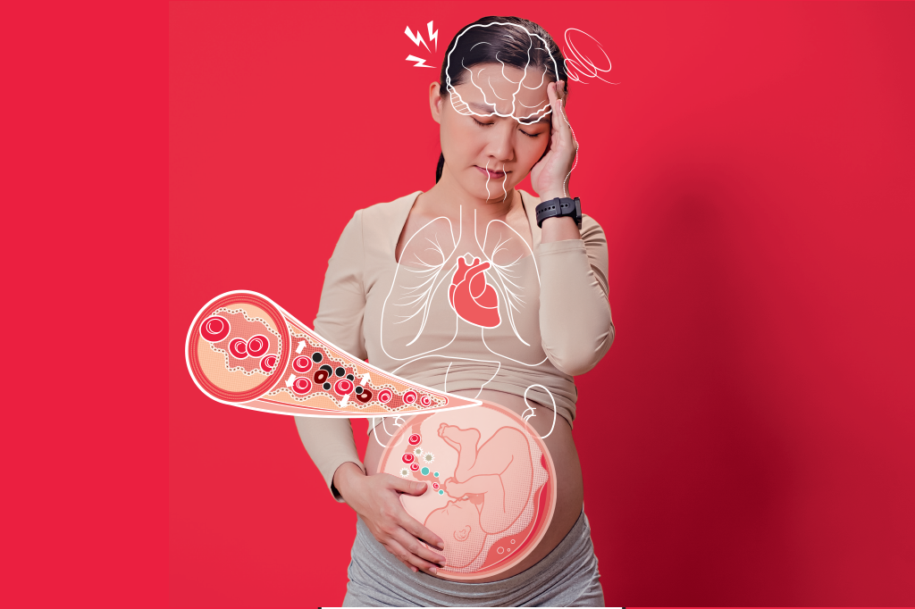 O que é a pré-eclâmpsia e por que ela preocupa tanto na gravidez?