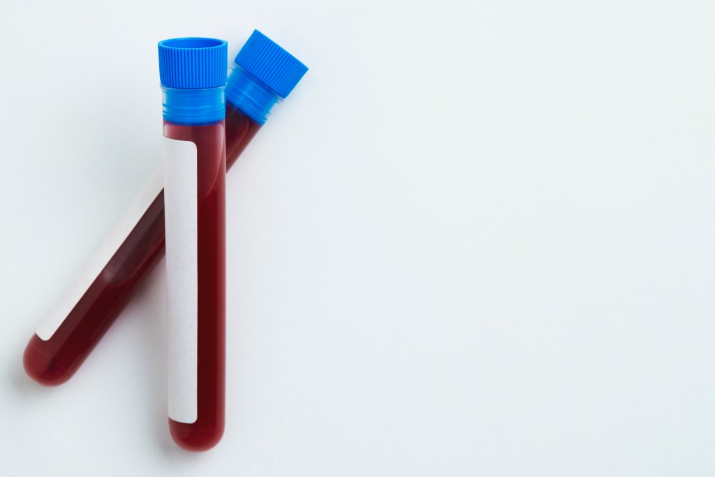 Creatinina alta: conheça 5 causas para o problema