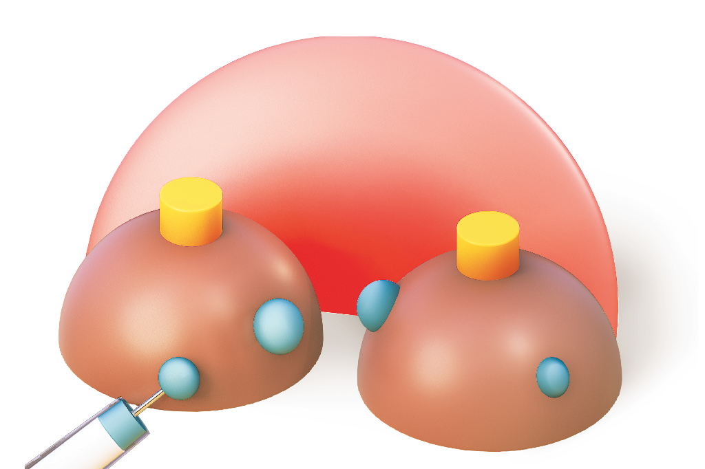 Câncer de mama: técnica que evita cirurgia e outras boas notícias