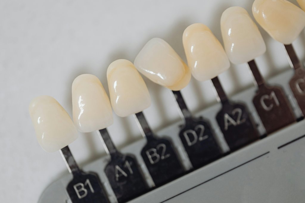 Facetas de resina ou porcelana: qual o melhor material para os dentes?
