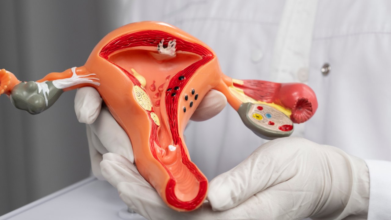transposicao-ovariana-cirurgia-cancer-prevencao