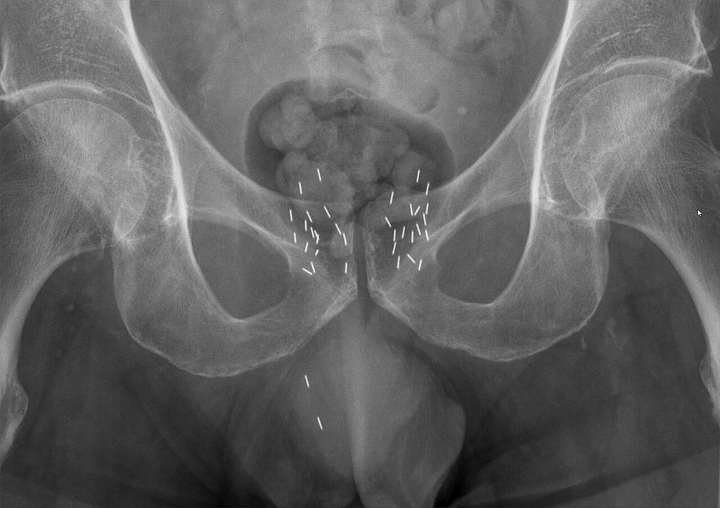 Braquiterapia: como funciona a “radioterapia interna”?