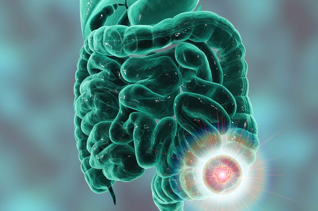 Março Azul: obesidade e diabetes elevam risco de câncer de intestino