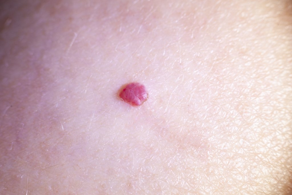 Conheça o carcinoma basocelular, câncer mais comum do Brasil