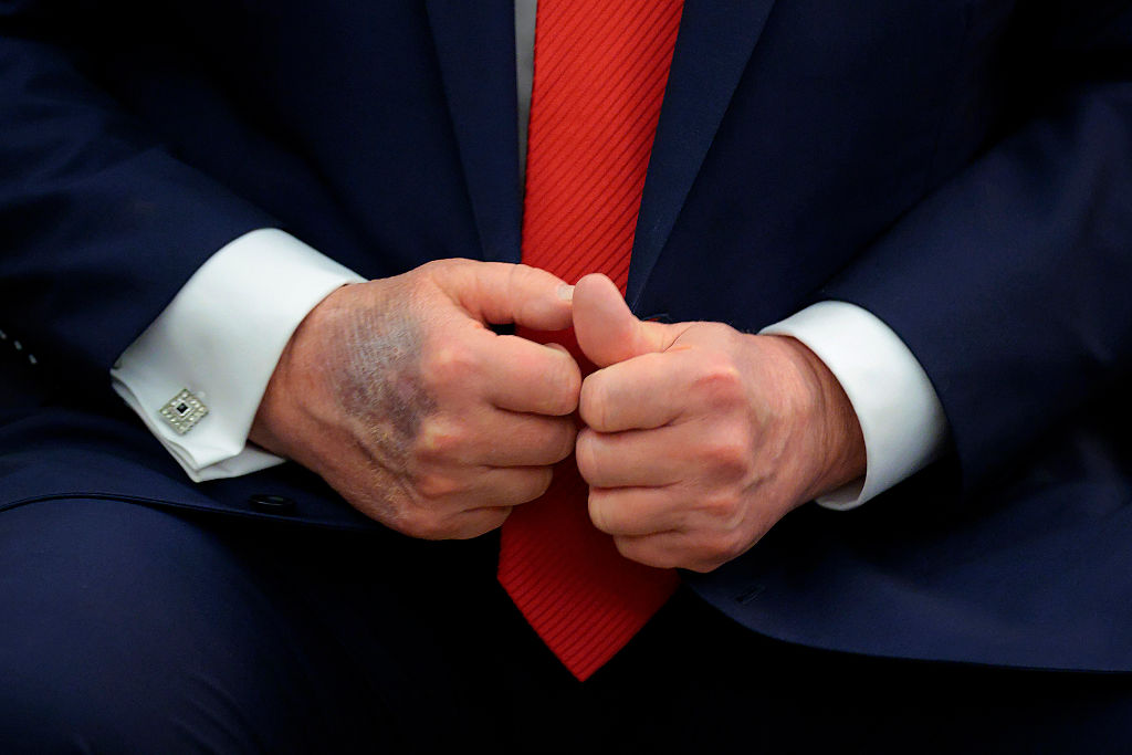 Donald Trump aparece com hematomas e maquiagem nas mãos