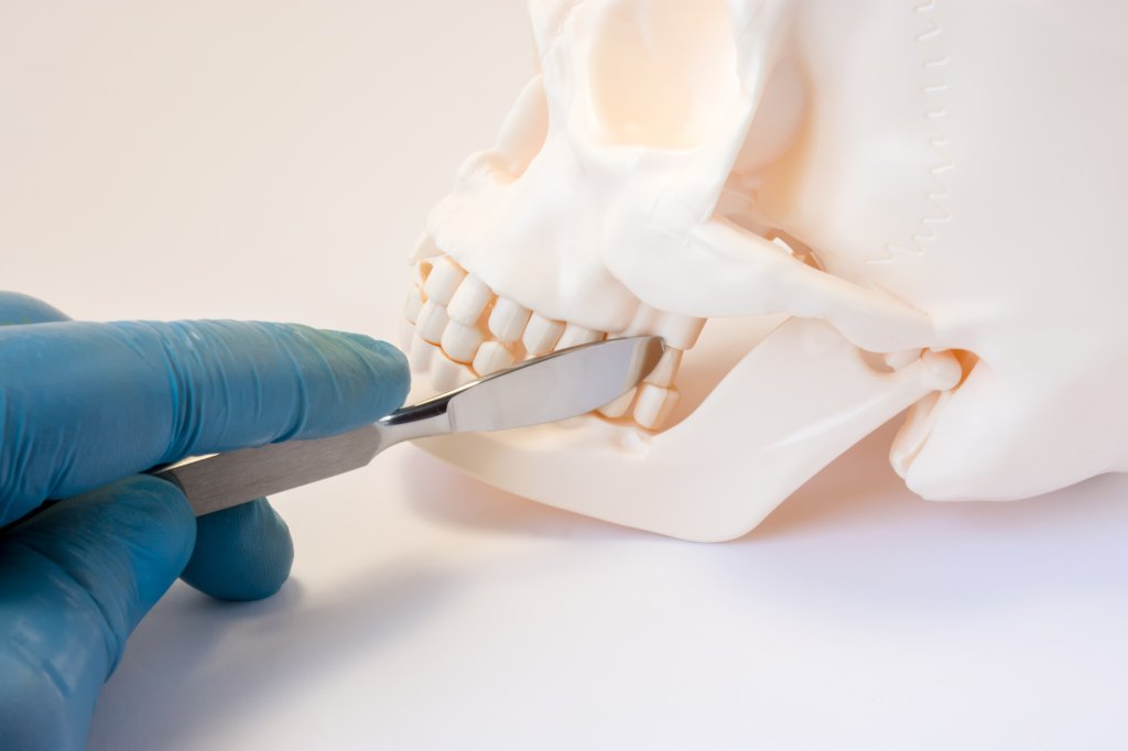 Cirurgia ortognática: quando fazer, como é o procedimento e a recuperação