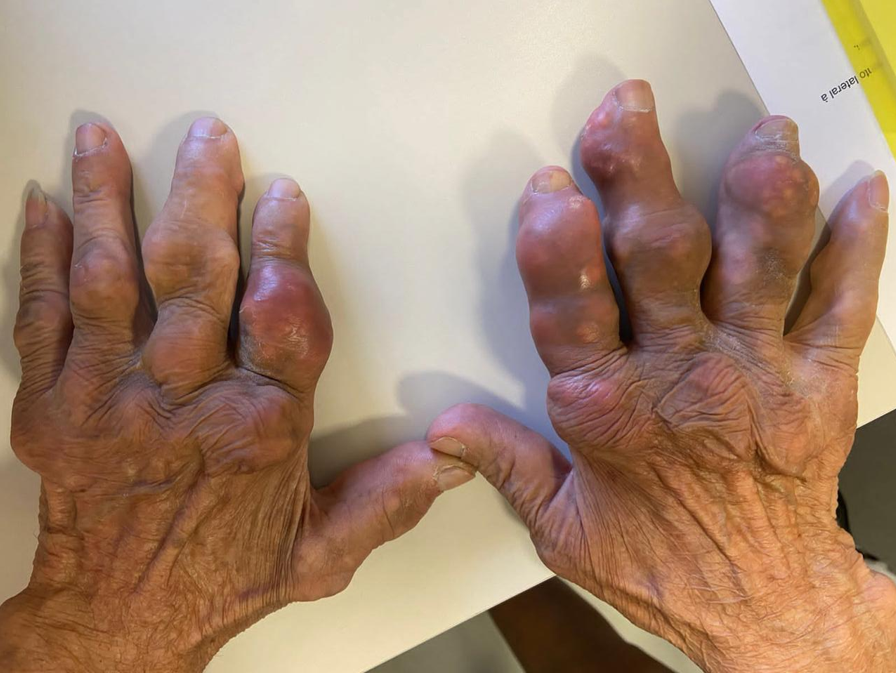 Gota: a “doença dos reis” que hoje ameaça a população em geral