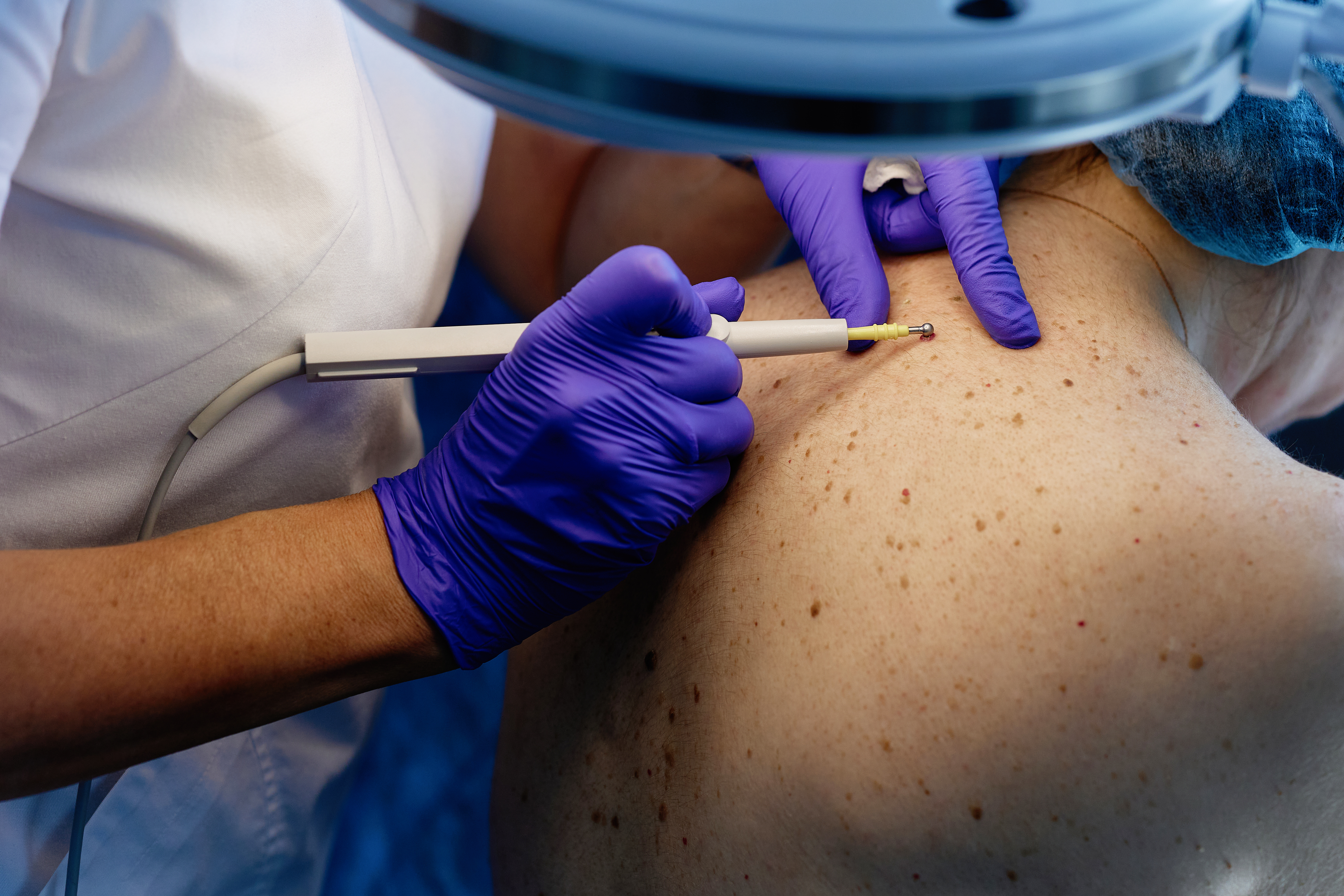 saude-medicina-dermatologia-diagnostico-biopsia-pele-cancer