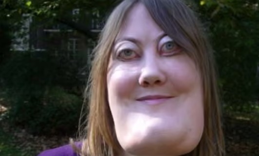 Querubismo: o que é, causas e como tratar