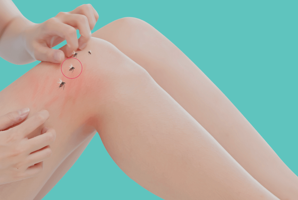 O que acontece no corpo numa picada de pernilongo? Saiba o que fazer